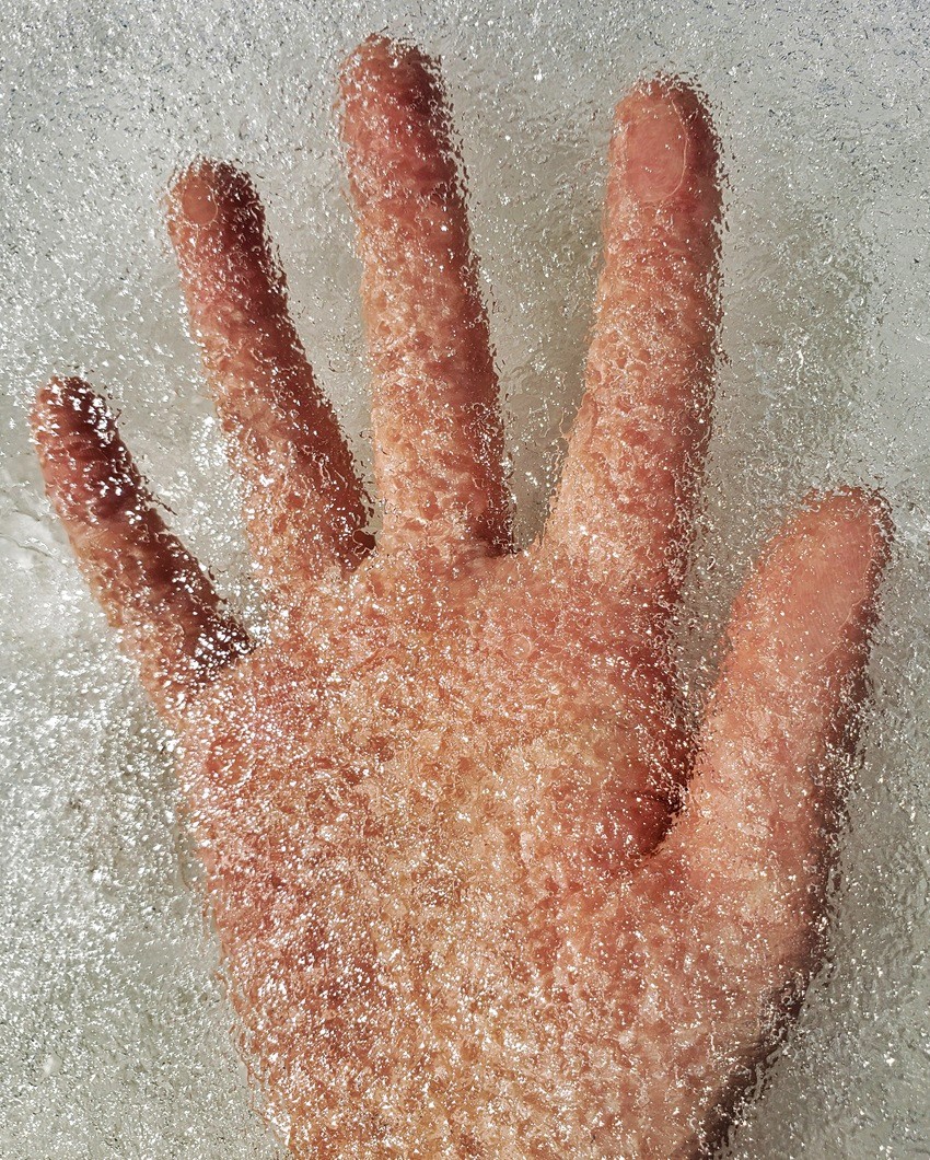 Morbus Dupuytren – Beugekontraktur der Hand Morbus Dupuytren mit Beugekontraktur der Finger